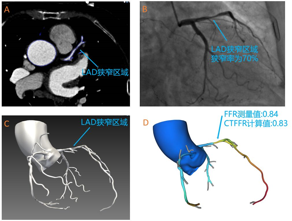 奧泰康助力睿心醫(yī)療—《冠狀動脈供血功能（CT-FFR）評估軟件》產(chǎn)品完成創(chuàng)新審評及臨床試驗